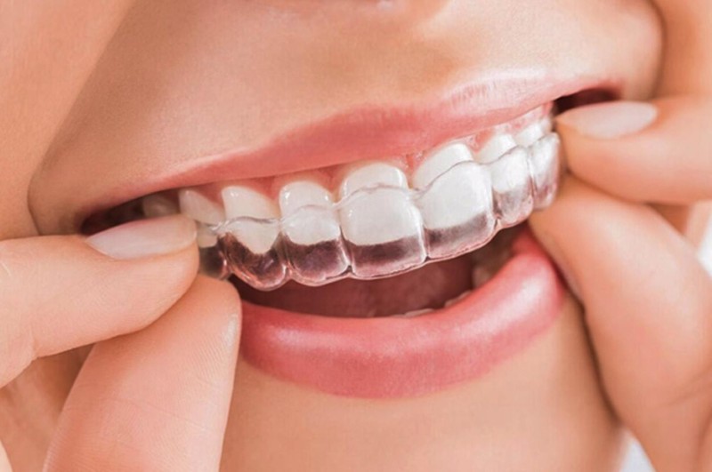 Niềng răng trong suốt giá bao nhiêu? Bảng giá mới nhất 2026 1 Niềng răng trong suốt là một phương pháp chỉnh nha bằng khay nhựa trong suốt