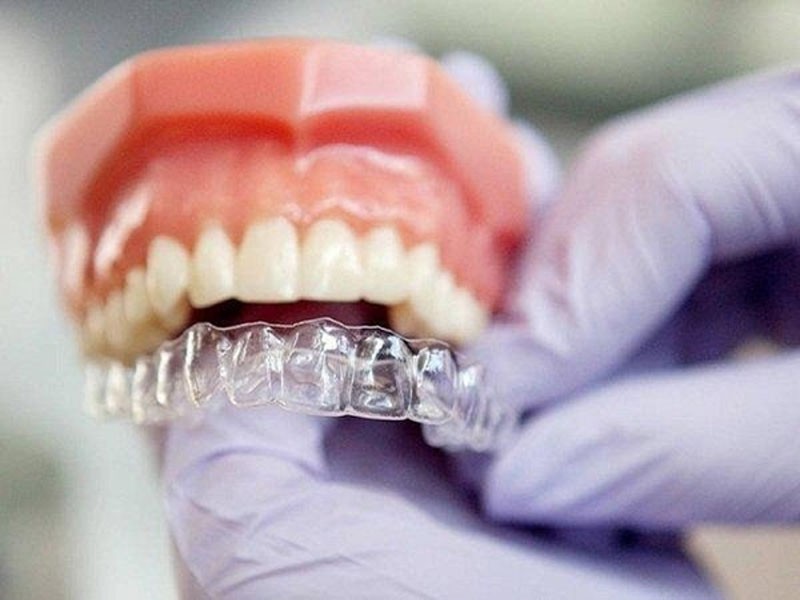 Niềng răng trong suốt giá bao nhiêu? Bảng giá mới nhất 2026 2 Niềng răng trong suốt giá bao nhiêu còn phụ thuộc vào nhiều yếu tố khác nhau