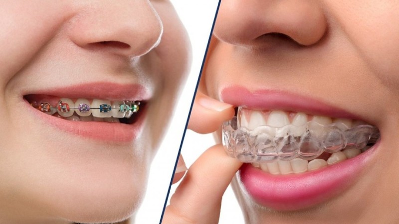 Niềng răng trong suốt giá bao nhiêu? Bảng giá mới nhất 2026 3 Giá phương pháp niềng răng trong suốt Invisalign thường cao hơn phương pháp niềng răng bằng mắc cài