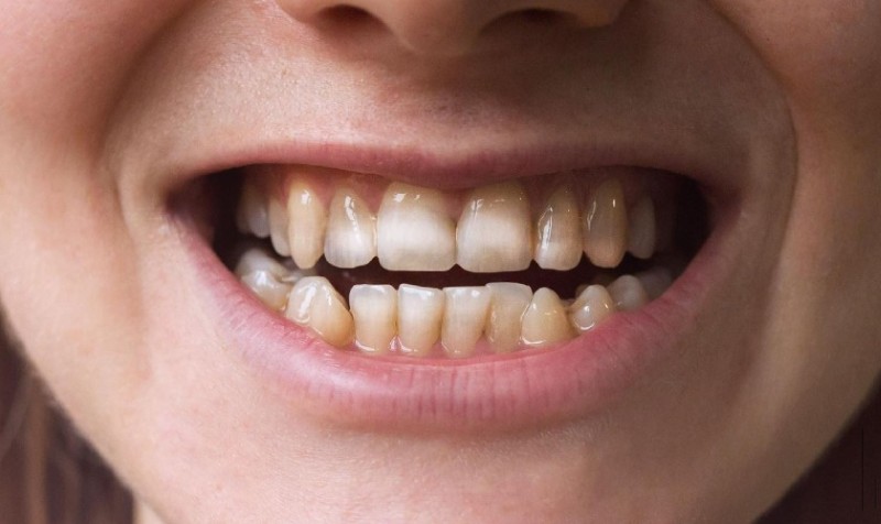 Thiểu sản men răng: Nguyên nhân, dấu hiệu và cách điều trị 1 Thiểu sản men răng là tình trạng tổn thương hoặc thiếu hụt men răng