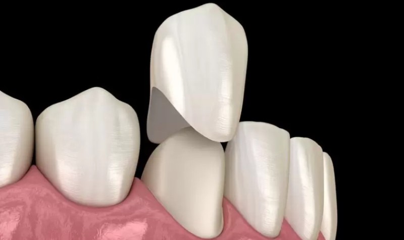 Thiểu sản men răng: Nguyên nhân, dấu hiệu và cách điều trị 10 Bọc răng sứ giúp bảo vệ răng trong trường hợp thiểu sản men răng nặng