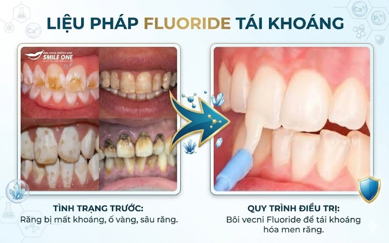 Thiểu sản men răng: Nguyên nhân, dấu hiệu và cách điều trị 7 Liệu pháp Fluoride tái khoáng là giải pháp hiệu quả trong trường hợp nhẹ của thiểu sản men răng