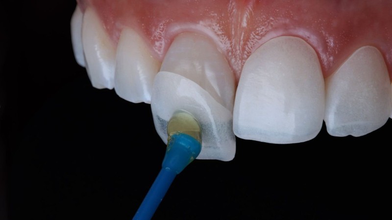 Thiểu sản men răng: Nguyên nhân, dấu hiệu và cách điều trị 9 Dán sứ Veneer là một phương pháp giúp cải thiện tình trạng thiểu sản men răng hiệu quả