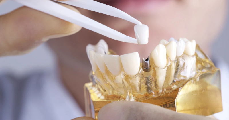 Trồng răng Implant có nguy hiểm không? Cách tránh biến chứng 1 Trồng răng Implant có nguy hiểm không?