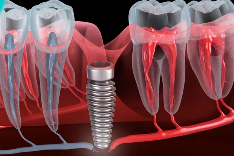 Trồng răng Implant có nguy hiểm không? Cách tránh biến chứng 3 Nguy cơ tổn thương mạch máu và dây thần kinh khi trồng răng implant