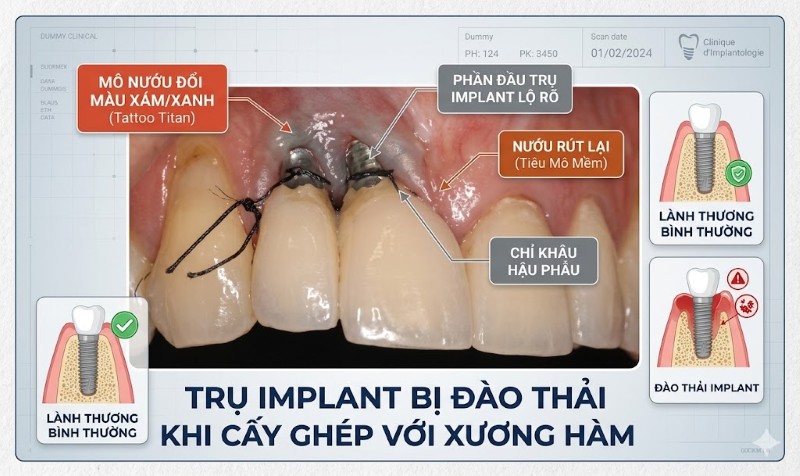 Trồng răng Implant có nguy hiểm không? Cách tránh biến chứng 4 Trụ Implant bị đào thải khi cấy ghép với xương hàm