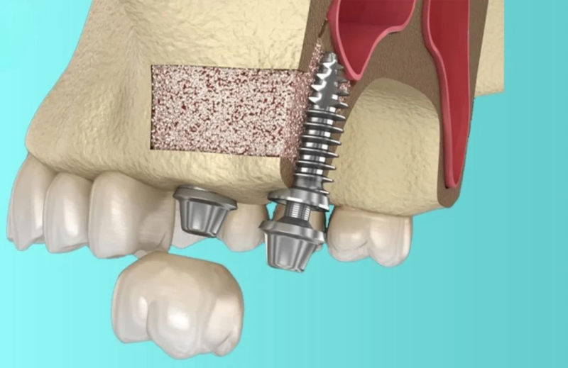 Trồng răng Implant có nguy hiểm không? Cách tránh biến chứng 5 Cấy ghép implant ở hàm trên có nguy cơ gây thủng xoang hàm