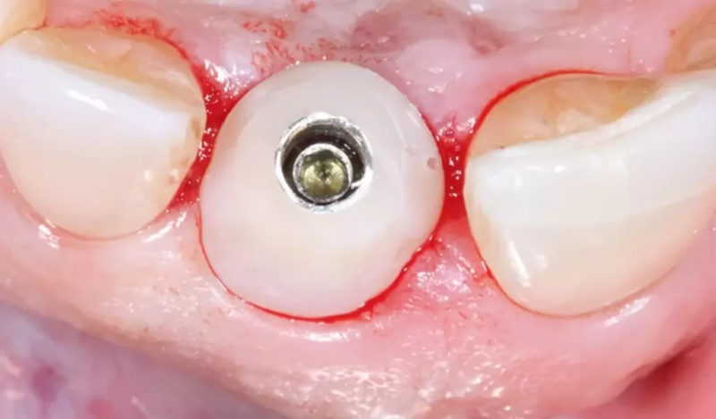 Trồng răng Implant có nguy hiểm không? Cách tránh biến chứng 6 Tình trạng chảy máu kéo dài và sưng đau bất thường sau khi cấy ghép implant