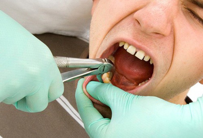 Nhổ răng có đau không? Sự thật và những lưu ý để không đau 2 Nhổ răng có đau không? Cảm giác đau khi nhổ răng và khi hết thuốc tê