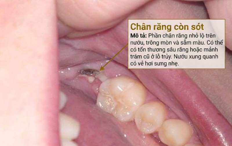 Nhổ răng còn sót chân răng có sao không? Cách xử lý an toàn 1 Chân răng bị sót sau khi nhổ