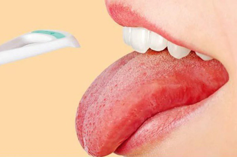 Rát lưỡi là bệnh gì? Nguyên nhân, dấu hiệu và cách điều trị 1 Hiện tượng rát lưỡi là gì?