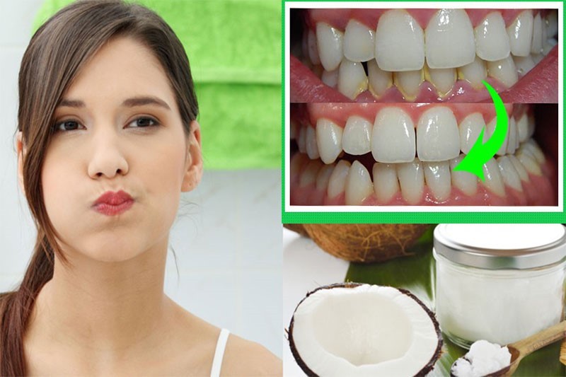 Súc miệng bằng dầu dừa: Tác dụng, cách làm và lưu ý y khoa 4 Dầu dừa có khả năng giúp ngăn ngừa sự hình thành mảng bám hiệu quả