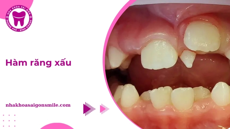 Hàm răng xấu: Nguyên nhân, tác hại và cách khắc phục hiệu quả - Nha ...