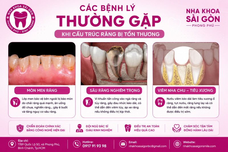 Cấu tạo răng người: Sơ đồ chi tiết và chức năng từng bộ phận 6 Các bệnh lý thường gặp khi cấu trúc răng bị tổn thương