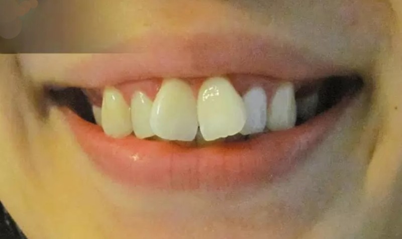 Răng cánh bướm: Nguyên nhân, tác hại và giải pháp từ bác sĩ 1 Răng cánh bướm là tình trạng răng cửa mọc xòe nhẹ sang hai bên