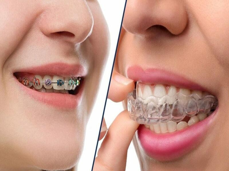 Răng cánh bướm: Nguyên nhân, tác hại và giải pháp từ bác sĩ 4 Niềng răng thẩm mỹ phương pháp phổ biến để điều chỉnh tình trạng răng cánh bướm