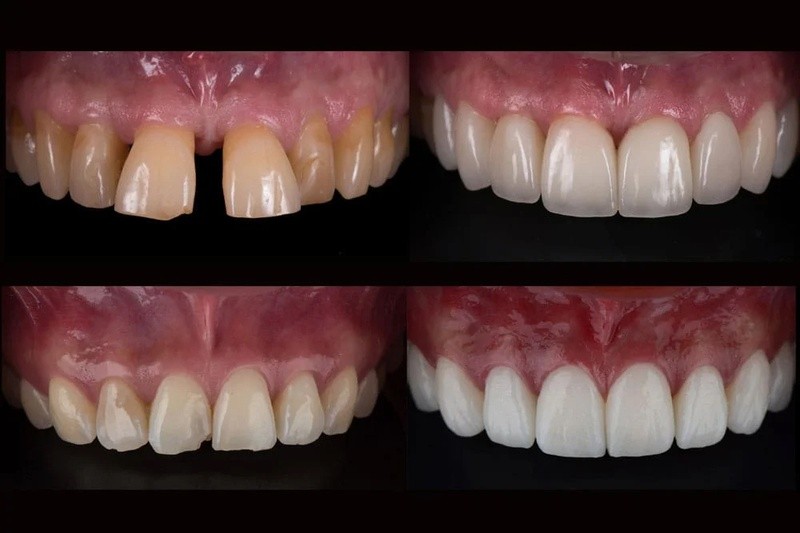 Răng cánh bướm: Nguyên nhân, tác hại và giải pháp từ bác sĩ 5 Bọc sứ cho răng cửa là giải pháp khắc phục tình trạng răng cánh bướm nhanh nhất