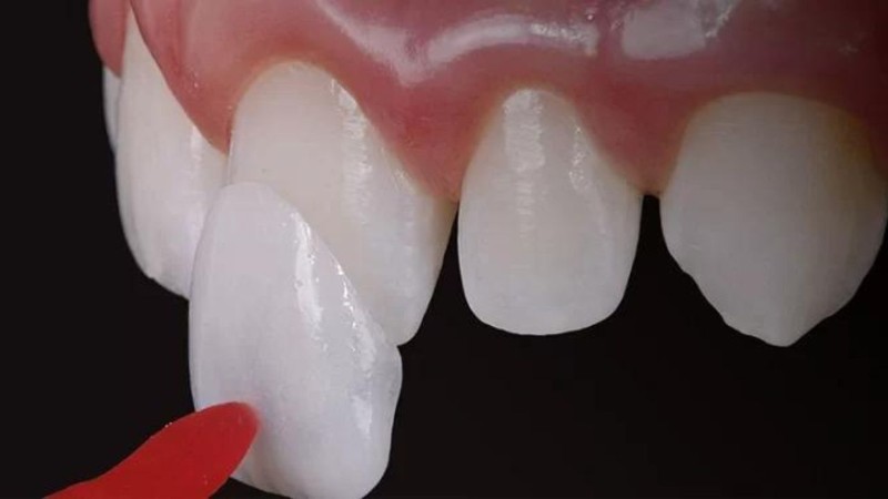 Răng cánh bướm: Nguyên nhân, tác hại và giải pháp từ bác sĩ 6 Dán sứ Veneer là lựa chọn phù hợp cho tình trạng răng cánh bướm nhẹ