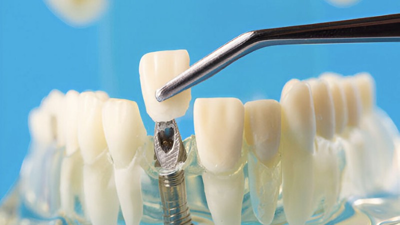 Răng sứ Alumina có tốt không? Ưu nhược điểm và giá bọc sứ 2 Ưu và nhược điểm của chất liệu sứ Alumina