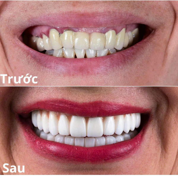 Bọc sứ 16 răng toàn hàm giá bao nhiêu tiền hiện nay? 5 Chiêm ngưỡng sự thay đổi ngoạn mục của khách hàng sau khi bọc 16 răng sứ