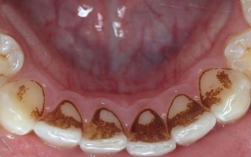 Cao răng đen: Nguyên nhân, tác hại và cách điều trị triệt để 1 Tình trạng cao răng đen ở mặt trong của răng hàm