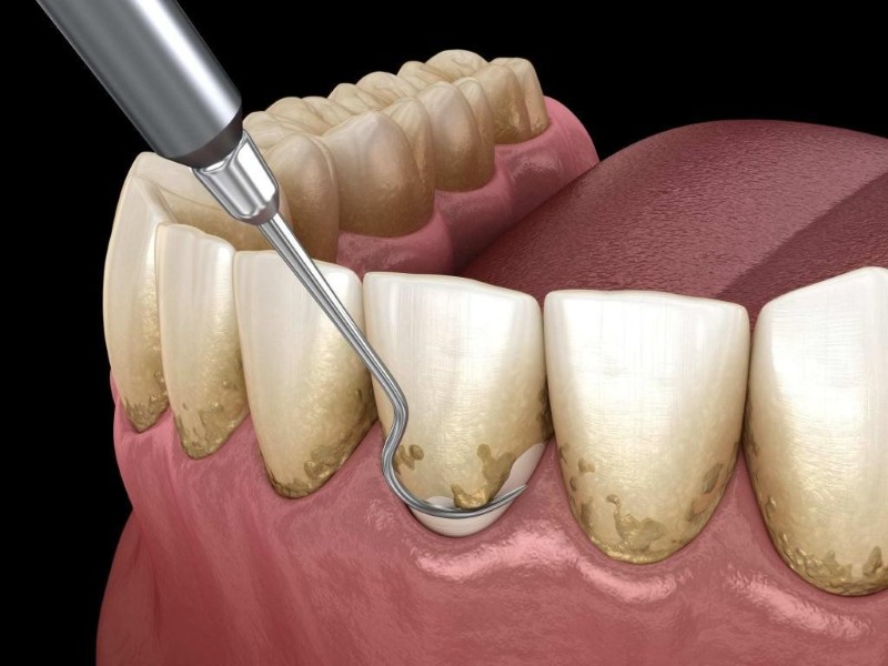 Cao răng đen: Nguyên nhân, tác hại và cách điều trị triệt để 2 Không lấy cao răng định kỳ dẫn đến tình trạng cao răng đen