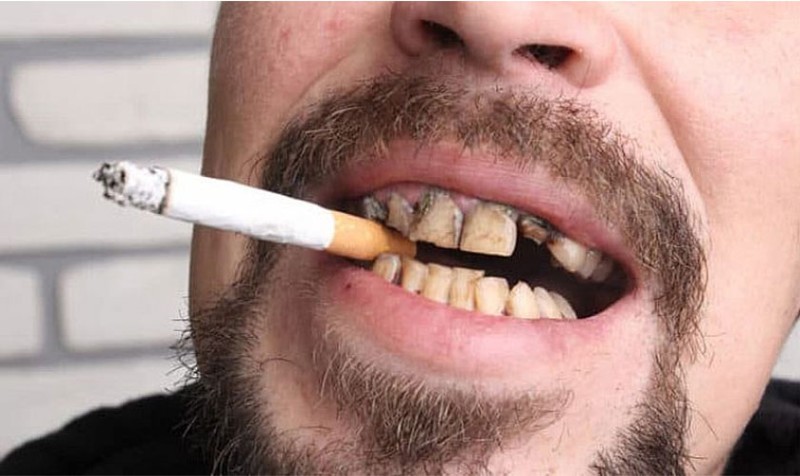 Cao răng đen: Nguyên nhân, tác hại và cách điều trị triệt để 3 Cao răng đen xuất hiện do thói quen hút thuốc lá và tiêu thụ thực phẩm có màu đậm