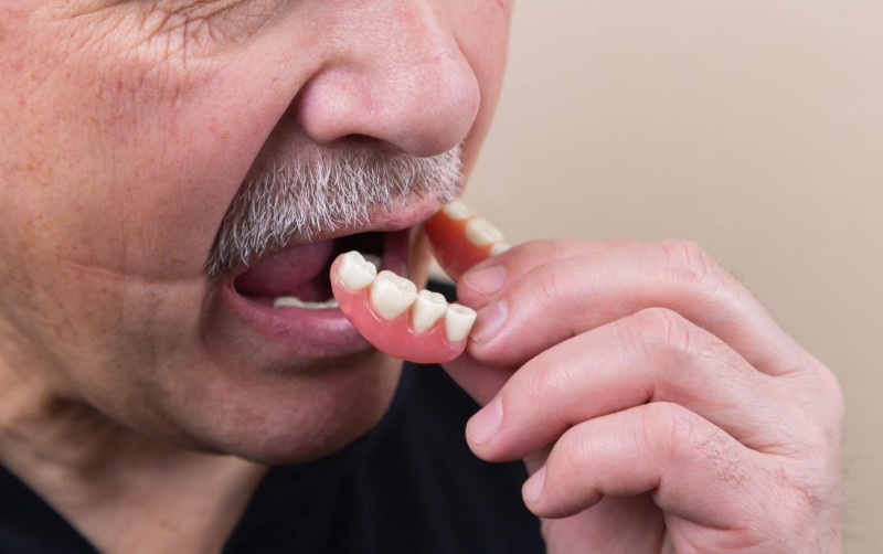 Hàm khung là gì? Ưu điểm, cách dùng và những điều cần lưu ý 7 Cách sử dụng và bảo quản hàm khung hiệu quả