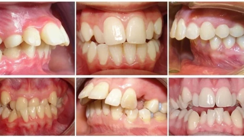 Hàm răng xấu: Nguyên nhân, tác hại và cách khắc phục hiệu quả 1 Tình trạng răng bị hô sai lệch khớp cắn