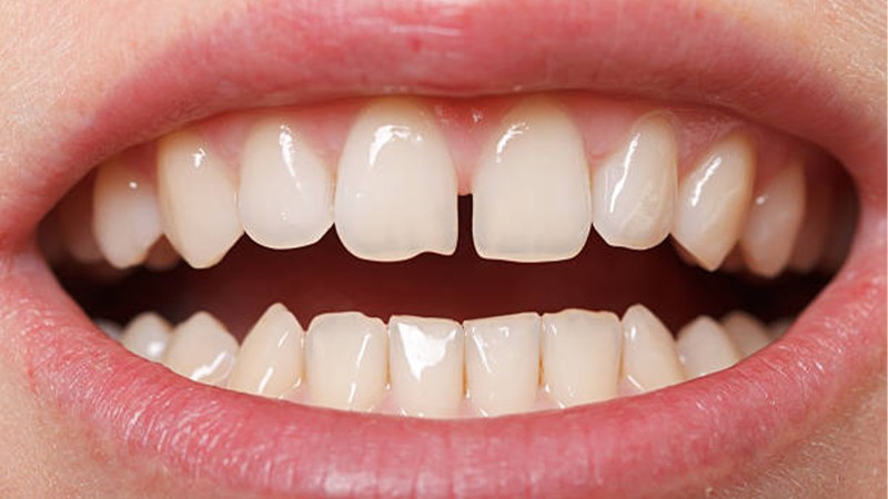Hàm răng xấu: Nguyên nhân, tác hại và cách khắc phục hiệu quả 2 Hàm răng xấu do răng bị thưa hở
