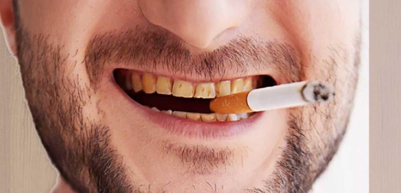Hàm răng xấu: Nguyên nhân, tác hại và cách khắc phục hiệu quả 3 Răng bị ố vàng do thói quen hút thuốc và sử dụng thực phẩm đậm màu