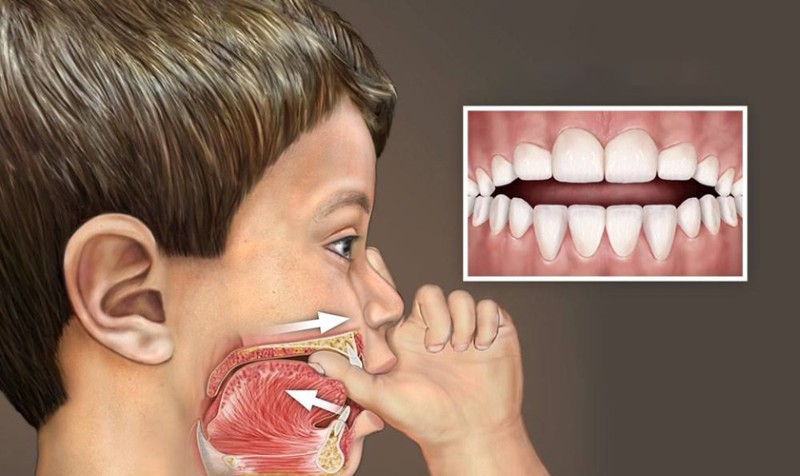 Hàm răng xấu: Nguyên nhân, tác hại và cách khắc phục hiệu quả 4 Thói quen mút tay của trẻ dẫn đến răng mọc lệch