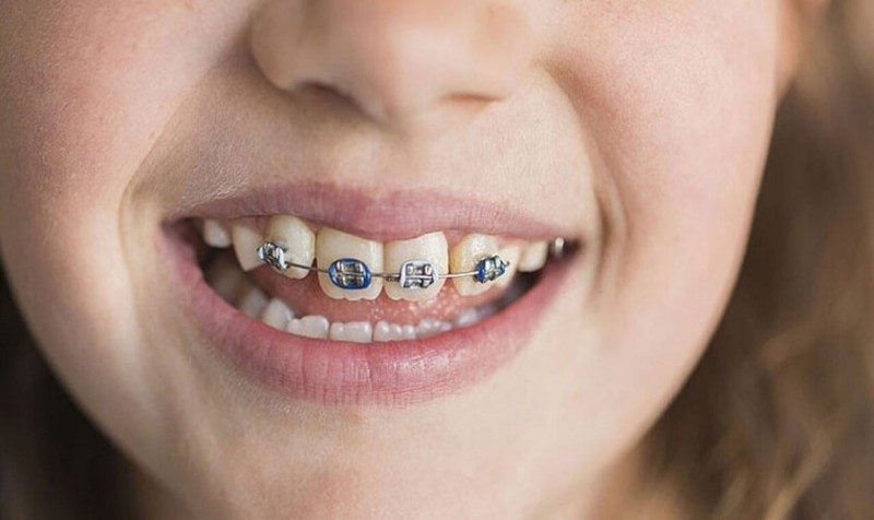 Hàm răng xấu: Nguyên nhân, tác hại và cách khắc phục hiệu quả 5 Niềng răng là phương pháp điều trị tình trạng hàm răng xấu hiệu quả