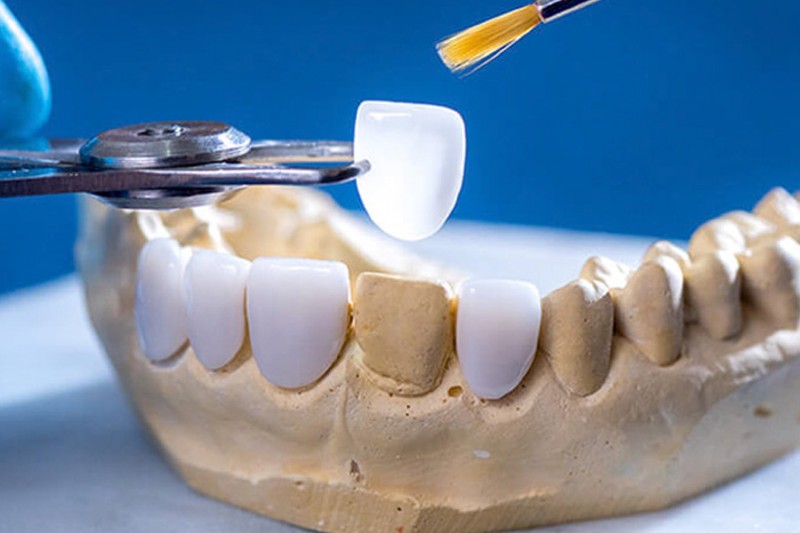 Hàm răng xấu: Nguyên nhân, tác hại và cách khắc phục hiệu quả 6 Dám sứ giúp cải thiện hàm răng