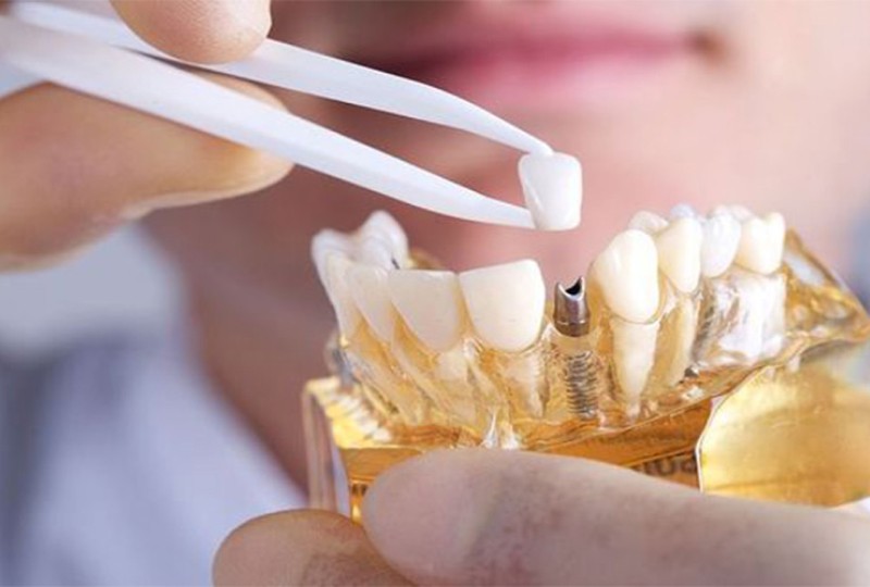 Hàm răng xấu: Nguyên nhân, tác hại và cách khắc phục hiệu quả 7 Phục hình răng bằng phương pháp trồng Implant