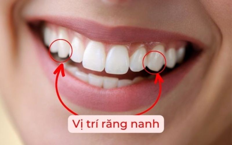 Người có 4 răng nanh nhọn là gì? Tốt hay xấu theo nhân tướng học? 1 Răng nanh là răng nằm ở vị trí thứ 3 từ ngoài vào trong của hàm răng