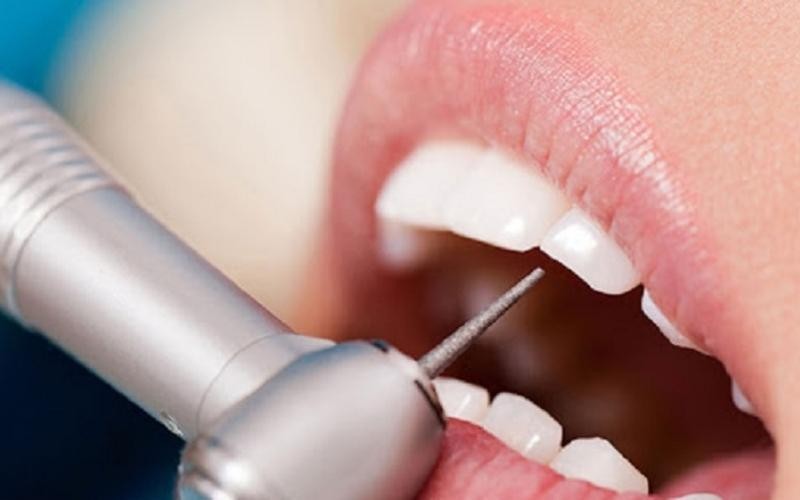 Người có 4 răng nanh nhọn là gì? Tốt hay xấu theo nhân tướng học? 4 Phương pháp mài răng thẩm mỹ giúp giảm độ nhọn của răng nanh