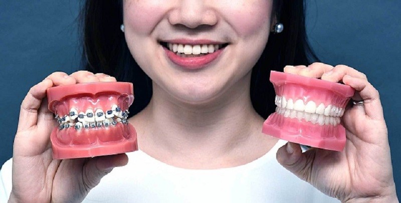 Người có 4 răng nanh nhọn là gì? Tốt hay xấu theo nhân tướng học? 5 Phương pháp niềng răng chỉnh nha giúp khắc phục răng nanh nhọn