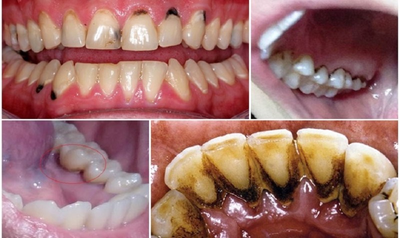 Răng bị đen trên bề mặt là gì? Nguyên nhân & cách xử lý hiệu quả 1 Tình trạng răng bị đen trên bề mặt