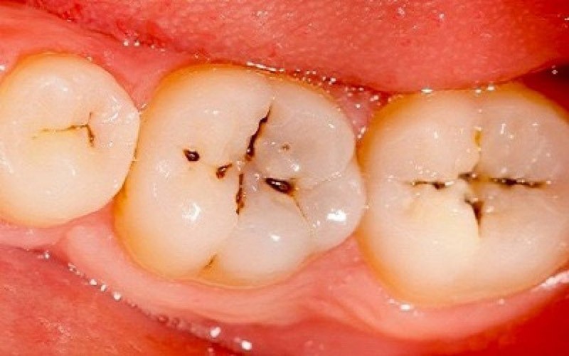 Răng bị đen trên bề mặt là gì? Nguyên nhân & cách xử lý hiệu quả 2 Răng bị đen trên bề mặt do sâu răng