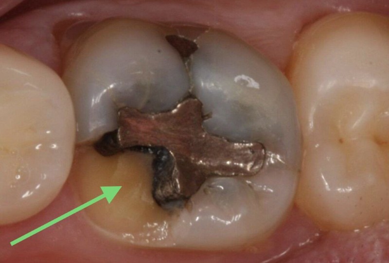Răng bị đen trên bề mặt là gì? Nguyên nhân & cách xử lý hiệu quả 3 Vật liệu trám răng cũ bị oxy hóa khiến răng bị đen trên bề mặt
