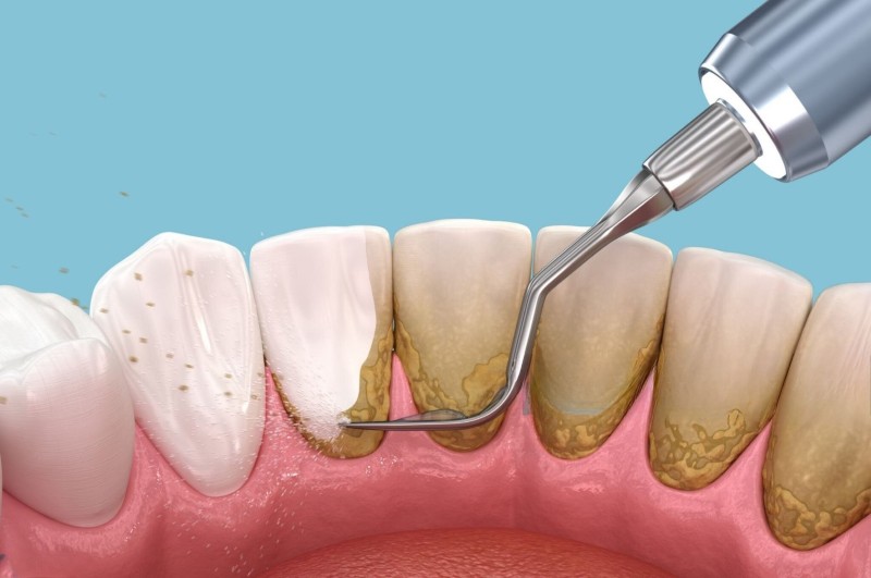 Răng bị đen trên bề mặt là gì? Nguyên nhân & cách xử lý hiệu quả 4 Cạo vôi răng giúp loại bỏ cao răng và cải thiện tình trạng răng bị đen trên bề mặt