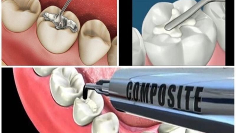Răng bị đen trên bề mặt là gì? Nguyên nhân & cách xử lý hiệu quả 5 Trám răng thẩm mỹ Composite hỗ trợ khôi phục hình dáng và màu sắc cho răng