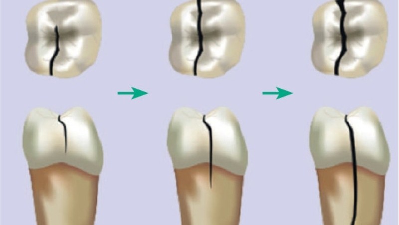 Răng bị vỡ dọc: Nguyên nhân, dấu hiệu và cách xử lý dứt điểm 1 Tình trạng răng bị vỡ dọc do tổn thương thường gặp