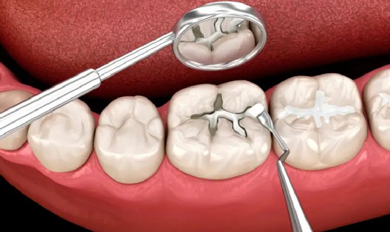 Răng bị vỡ dọc: Nguyên nhân, dấu hiệu và cách xử lý dứt điểm 3 Hàn trám thẩm mỹ là phương pháp đơn giản và hiệu quả khi răng bị vỡ dọc
