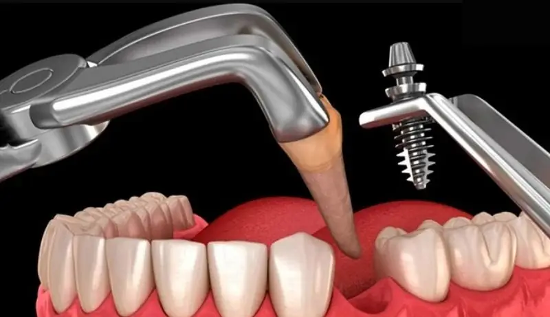 Răng bị vỡ dọc: Nguyên nhân, dấu hiệu và cách xử lý dứt điểm 4 Nhổ răng và cấy ghép Implant khi răng không thể phục hồi