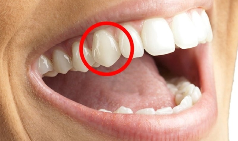 Răng số 3 là răng nào? Vị trí, chức năng và các lưu ý y khoa 1 Vị ví răng số 3 trong hàm răng