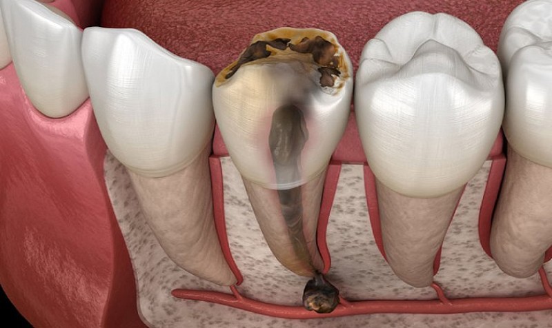 Răng số 3 là răng nào? Vị trí, chức năng và các lưu ý y khoa 3 Răng số 3 bị sâu dẫn đến viêm tủy răng