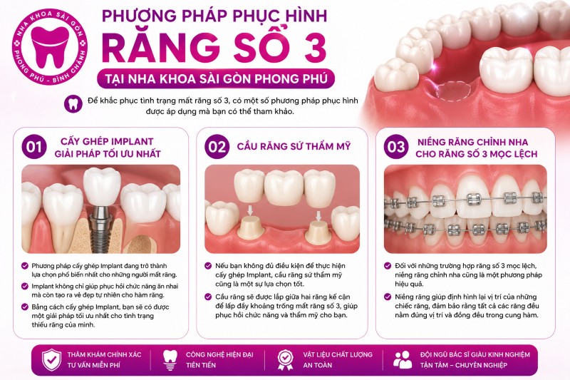 Răng số 3 là răng nào? Vị trí, chức năng và các lưu ý y khoa 4 Các phương pháp phục hình răng số 3 tại Nha khoa Sài Gòn Phong Phú