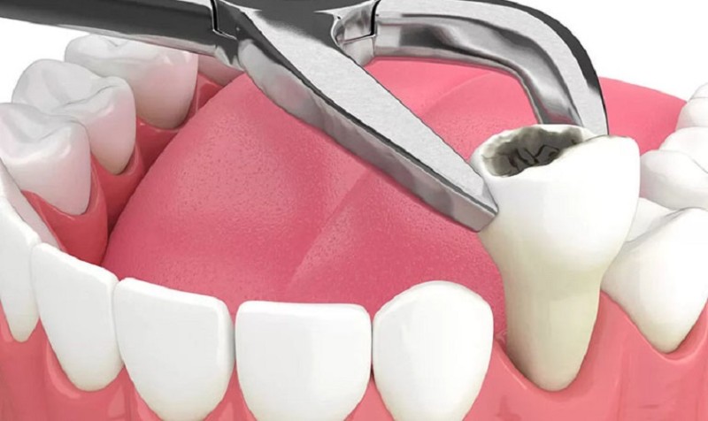 Răng số 4 là răng gì? Vị trí, chức năng và những lưu ý quan trọng 5 Nhổ răng khi bị sâu nặng và không thể bảo tồn